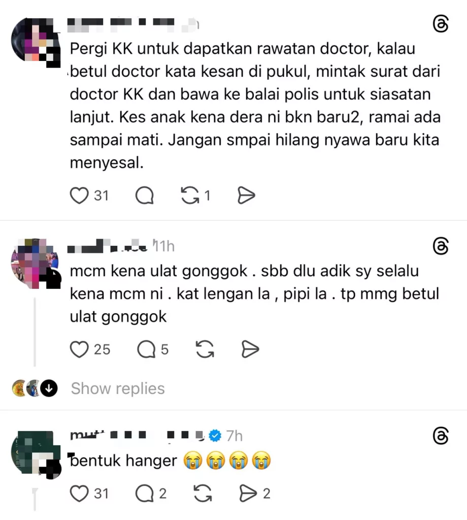 Ibu Risau, Wajah Anak Bawah Jagaan Pengasuh Ada Kesan Birat Seperti ‘Hanger’