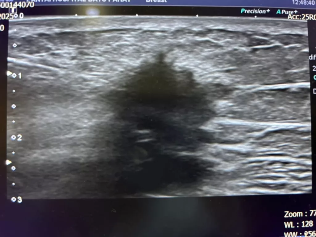 Jumpa Pesakit Kanser Setiap Hari, Pakar Radiologi Luah Risau Tentang Kanser Payudara