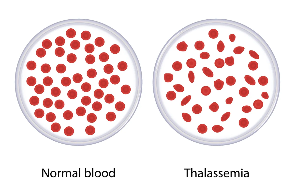 Suami Isteri Pembawa Thalassemia: Fakta Penting, Risiko Serius & Pilihan Bertanggungjawab