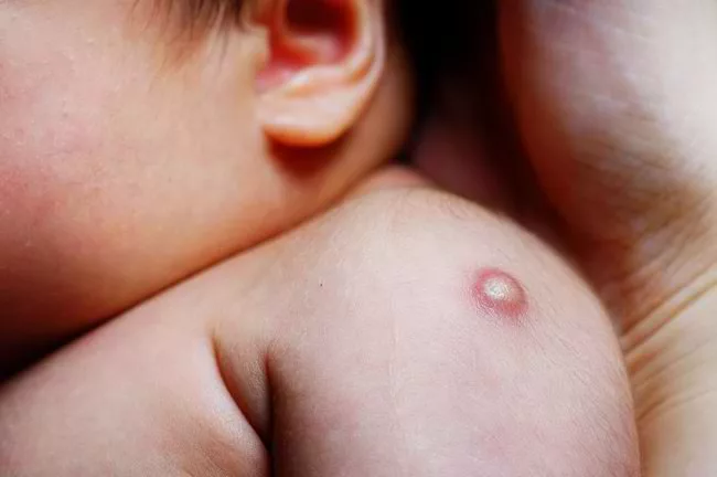 Parut Suntikan BCG Bayi: Fakta Sebenar Yang Ramai Ibu Bapa Tak Tahu