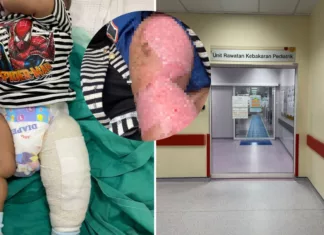 Bapa Terkejut Air Paip Tiba-Tiba Jadi Panas Ketika Bersihkan Anak, Kaki Melecur Teruk