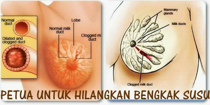 Bengkak Susu Bukan Perkara Remeh, Jika Dibiarkan Boleh Undang Komplikasi Serius