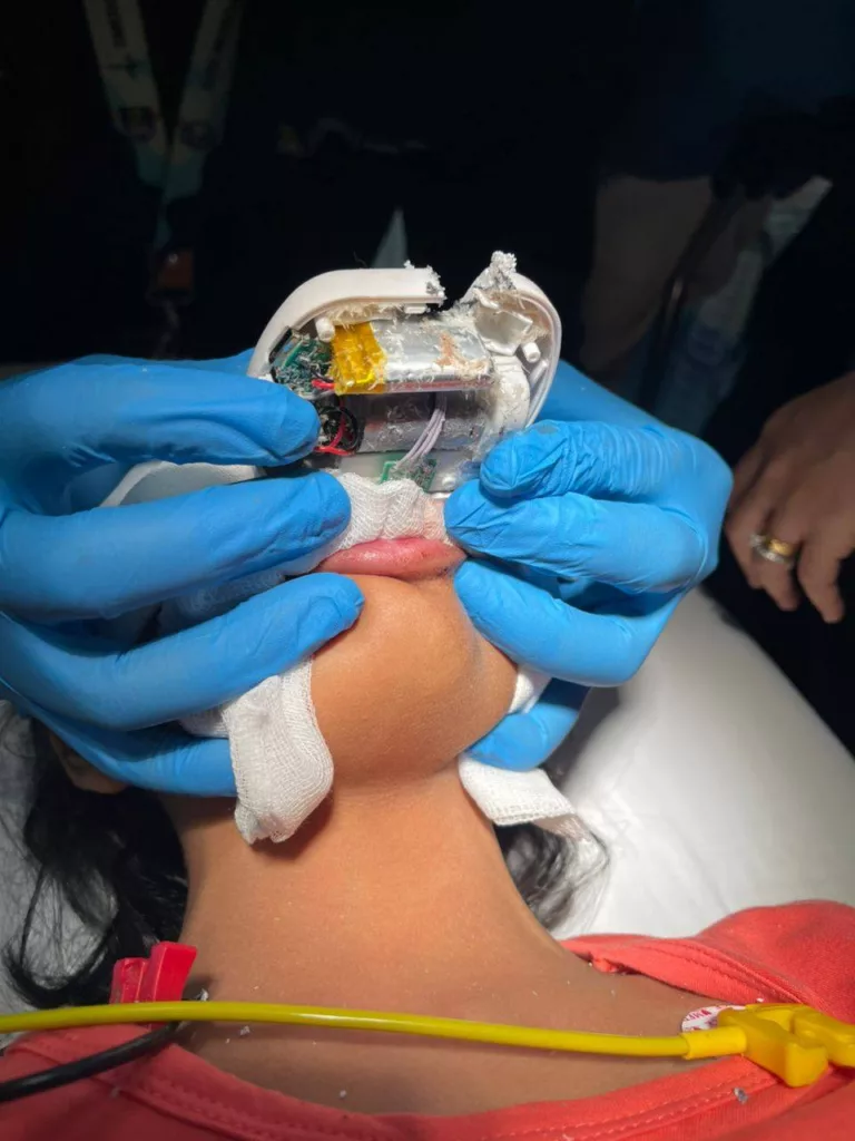 Sifat Ingin Mencuba Buat Bibir Kanak-Kanak 8 Tahun Tersepit Pengepit Kuku Elektrik!