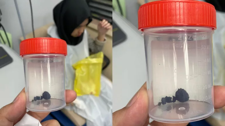 Hidung Anak Berdarah & Hingus Berbau Busuk, Rupanya Ada Objek Dalam Hidung Anak!