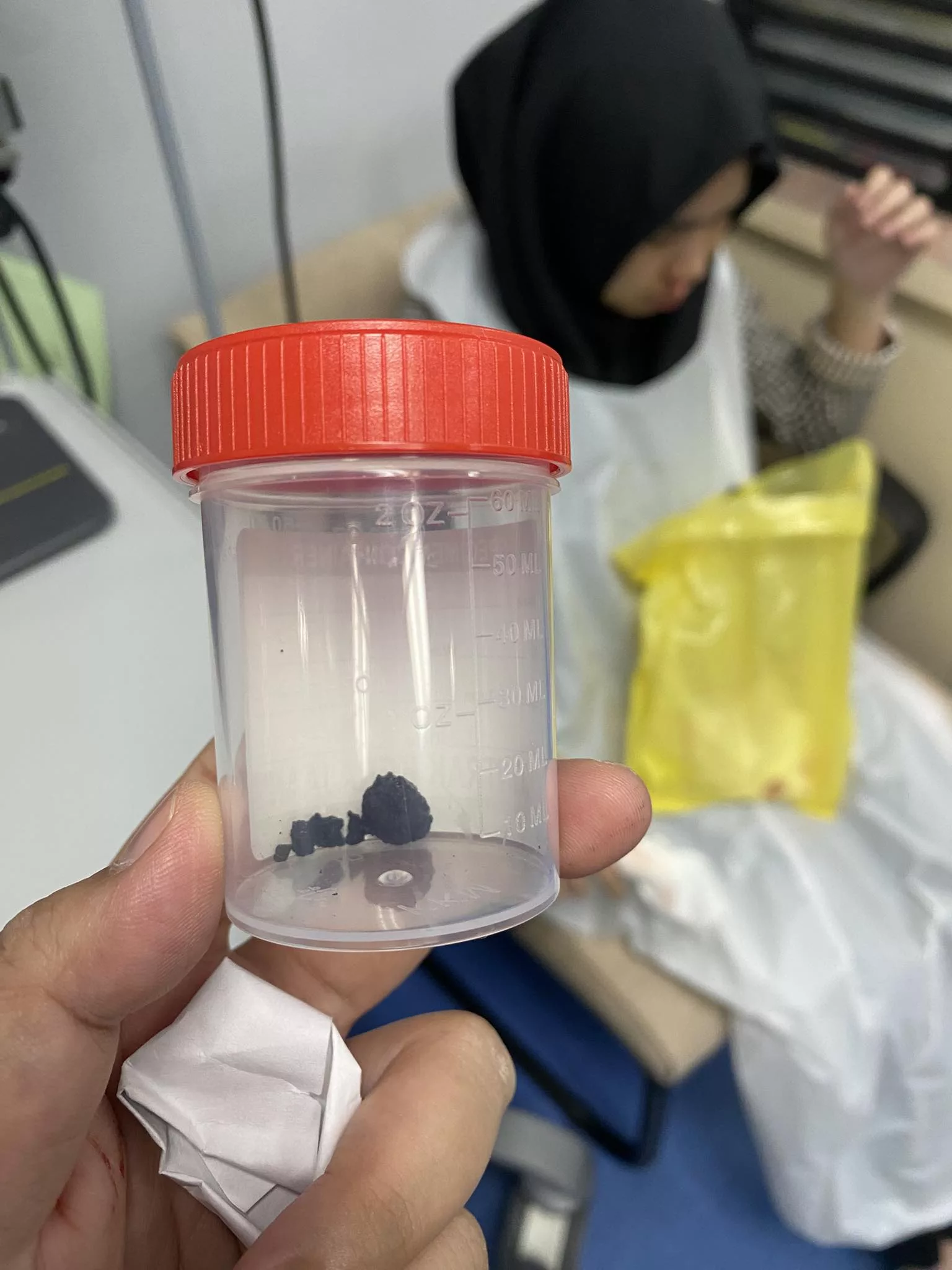 Hidung Anak Berdarah & Hingus Berbau Busuk, Rupanya Ada Objek Dalam Hidung Anak!