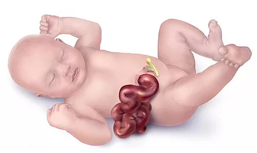“Masa Scan Doktor Cakap Usus Bayi Di Luar Perut…” Ibu Ini Kongsi Perjalanan Anak Hidap Gastroschisis 10 “Masa Scan Doktor Cakap Usus Bayi Di Luar Perut…” Ibu Ini Kongsi Perjalanan Anak Hidap Gastroschisis