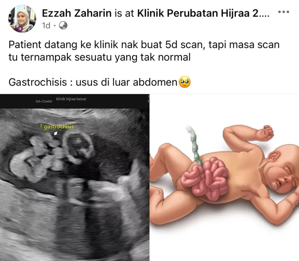 “Masa Scan Doktor Cakap Usus Bayi Di Luar Perut…” Ibu Ini Kongsi Perjalanan Anak Hidap Gastroschisis 11 “Masa Scan Doktor Cakap Usus Bayi Di Luar Perut…” Ibu Ini Kongsi Perjalanan Anak Hidap Gastroschisis