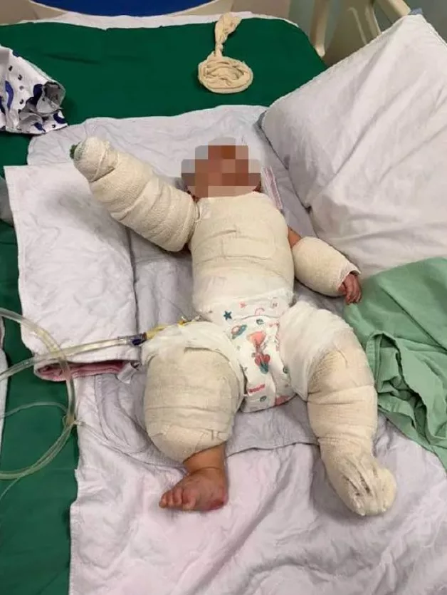Bayi 5 Bulan Melecur Teruk Tarik Wayar Periuk Nasi, Ibu Ayah Perlu Lebih Peka 4 Bayi 5 Bulan Melecur Teruk Tarik Wayar Periuk Nasi, Ibu Ayah Perlu Lebih Peka