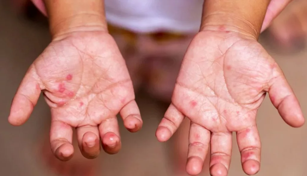 HFMD Meningkat: Panduan Penting Ibu Ayah Elak Panik Bila Anak Dijangkiti