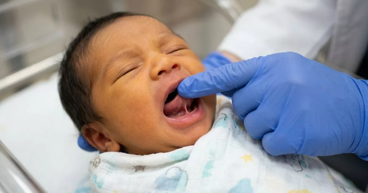 Tongue-Tie Mungkin Punca Bayi Sukar Menyusu, Jangan Terus Salahkan Susu Ibu!
