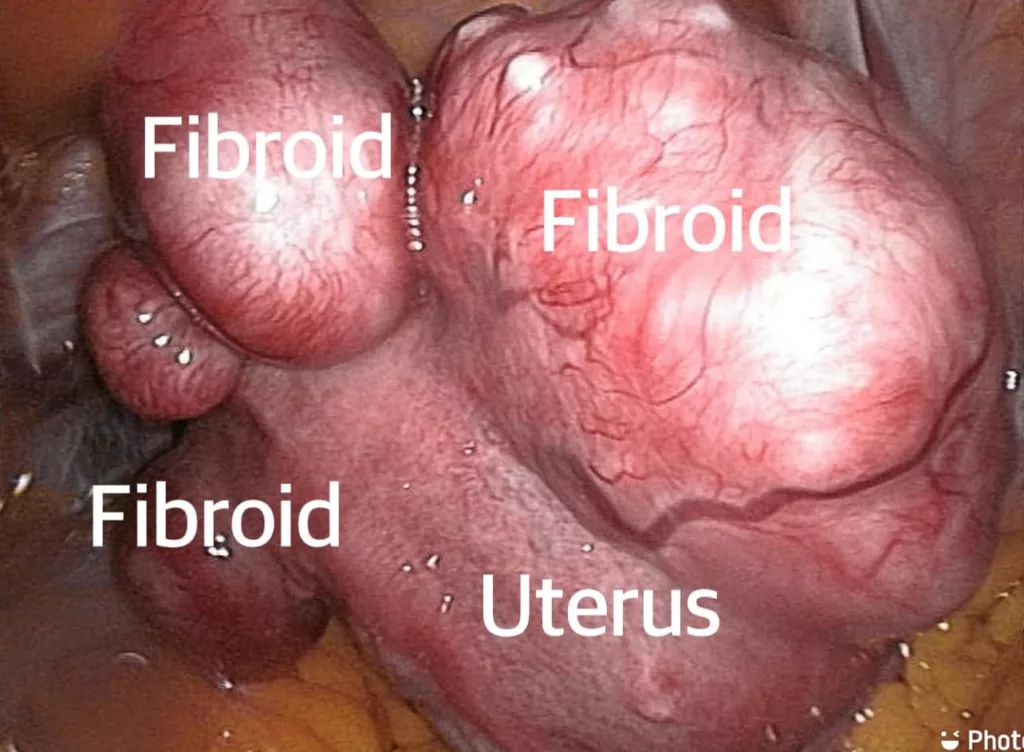 Fibroid Rahim Boleh Datang Tanpa Tanda! Pakar Dedah Punca, Faktor Risiko & Cara Kurangkan Risiko