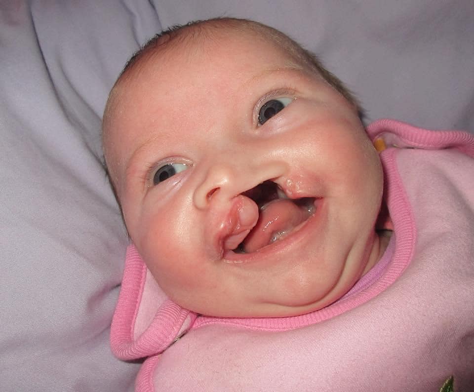 Sumbing Bibir dan Lelangit Pada Bayi: Punca, Risiko & Rawatan Yang Ramai Ibu Ayah Perlu Tahu 4 Sumbing Bibir dan Lelangit Pada Bayi: Punca, Risiko & Rawatan Yang Ramai Ibu Ayah Perlu Tahu