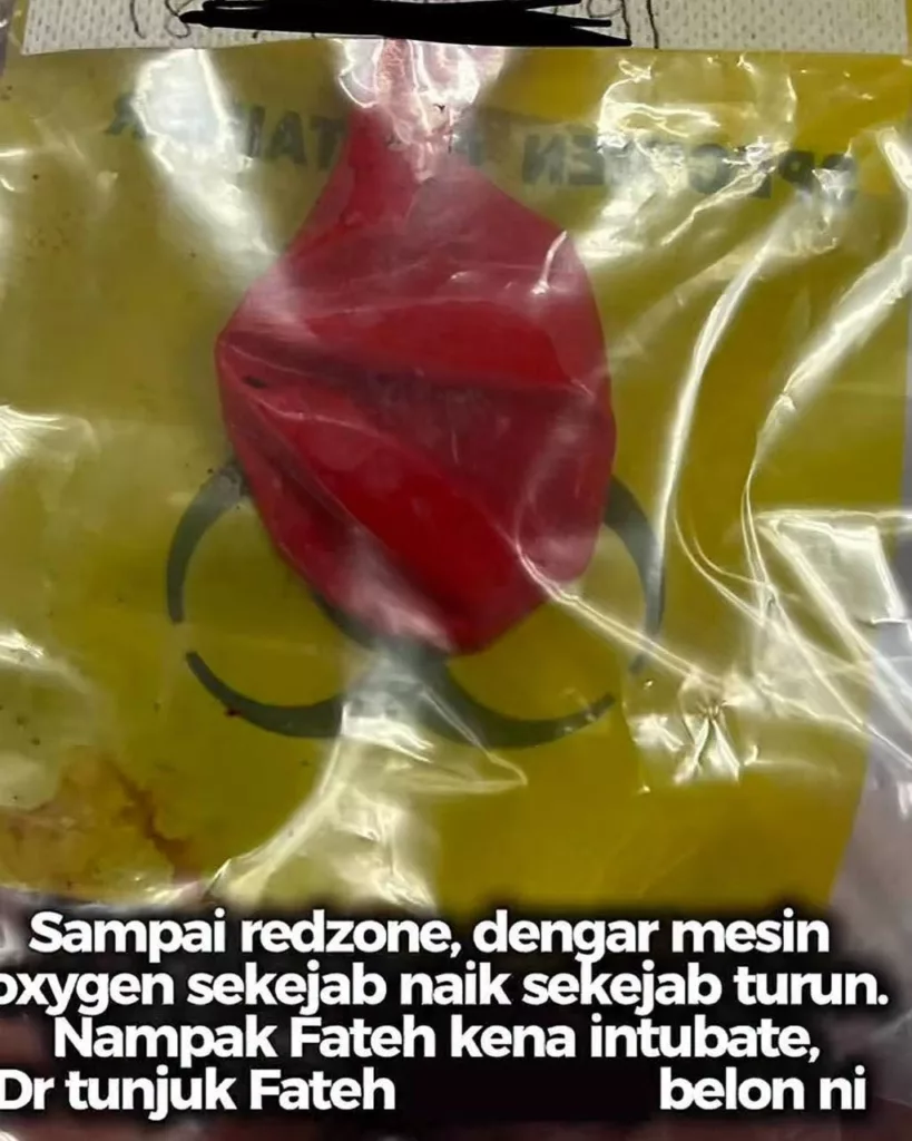 Detik Cemas Disangka Serangan Asma, Rupanya Belon Tersangkut Dalam Saluran Pernafasan Anak