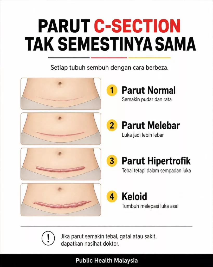 Parut C-Section Tak Semestinya Sama, Kenali 4 Jenis Parut Selepas Bersalin! 7 Parut C-Section