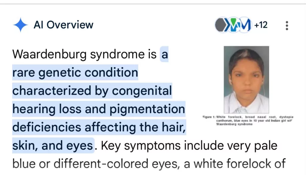Rambut Bayi Putih Macam ‘Highlight’ Natural Rupanya Ini Tanda Waardenburg Syndrome 9 Rambut Bayi Putih Macam ‘Highlight’ Natural Rupanya Ini Tanda Waardenburg Syndrome