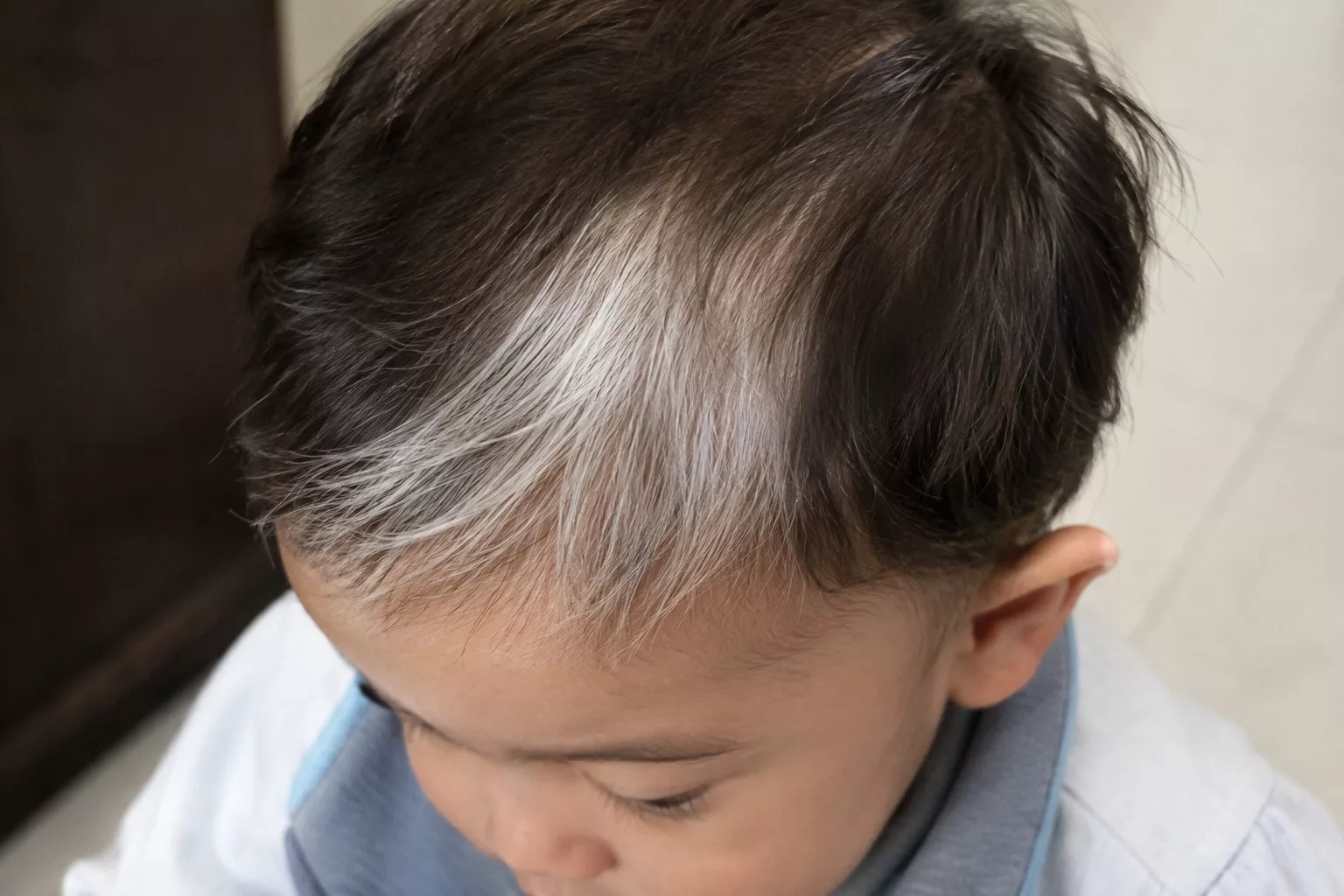 Rambut Bayi Putih Macam ‘Highlight’ Natural Rupanya Ini Tanda Waardenburg Syndrome 8 Rambut Bayi Putih Macam ‘Highlight’ Natural Rupanya Ini Tanda Waardenburg Syndrome