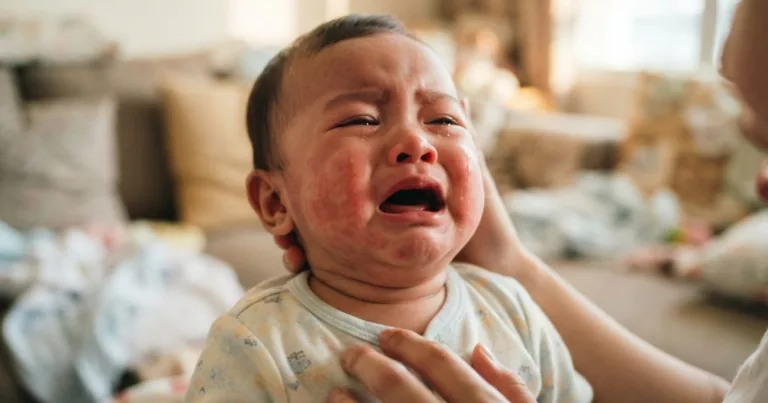 Erythema Toxicum Neonatorum! Jangan Panik, Ruam Biasa Pada Bayi Baru Lahir 4 Erythema Toxicum Neonatorum!