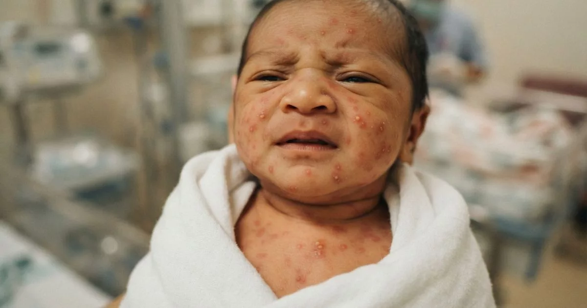 Erythema Toxicum Neonatorum! Jangan Panik, Ruam Biasa Pada Bayi Baru Lahir 5 Erythema Toxicum Neonatorum!