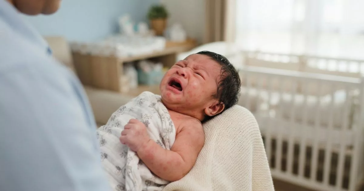 Erythema Toxicum Neonatorum! Jangan Panik, Ruam Biasa Pada Bayi Baru Lahir 3 Erythema Toxicum Neonatorum!