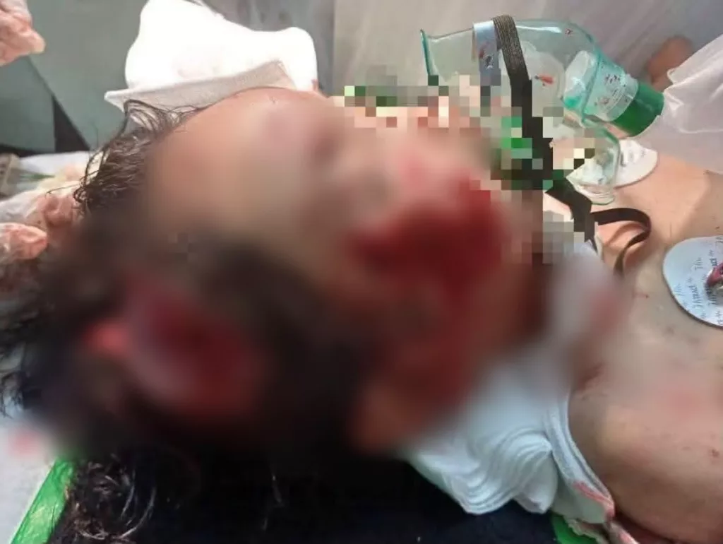 “Saya Nampak Depan Mata Sendiri Acik.” Abang Haira Trauma Lihat Adik Diserang Anjing Liar