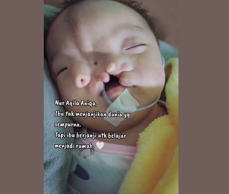 Anak Diuji Tessier Facial Cleft, Ibu Ini Reda “Ini Ladang Pahala Buat Saya” 5 Anak Diuji Tessier Facial Cleft, Ibu Ini Reda “Ini Ladang Pahala Buat Saya”